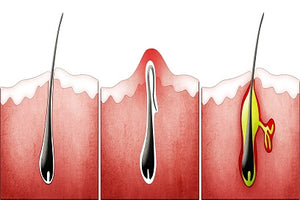 Ingrown hairs