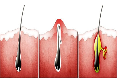 Ingrown hairs